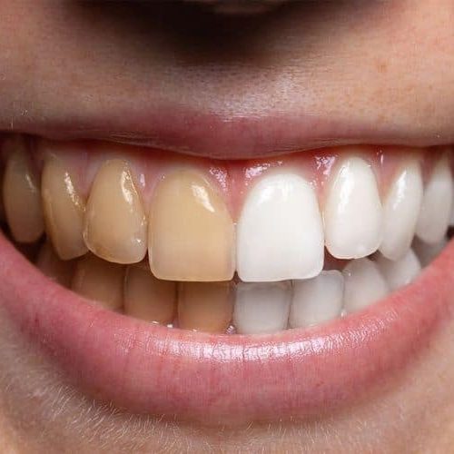 How to Get Rid of Coffee Stains on Teeth: Quick Tips